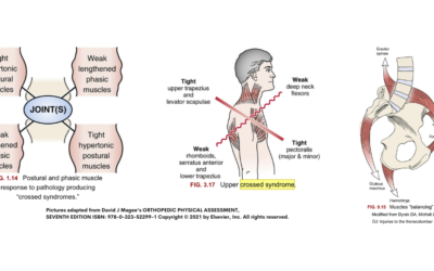 Janda’s Cross Syndromes.